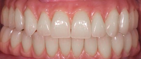 teeth in a day east cooper dental