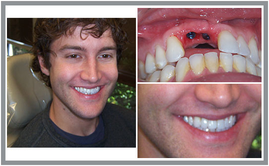 Dental Patient Before & After | East Cooper Dental | Family Dentists in Charleston SC