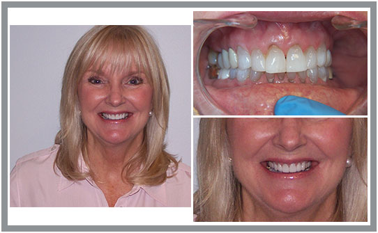 Dental Patient Case Study | East Cooper Dental | Family Dentists in Charleston SC