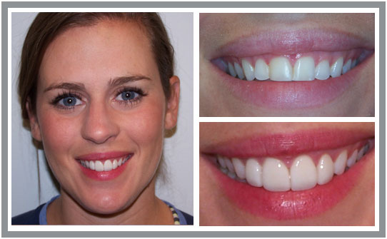 Dental Patient Smile Makeover Before & After | East Cooper Dental | Family Dentists in Charleston SC