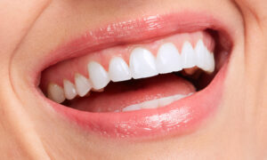 teeth whitening in Charleston, SC