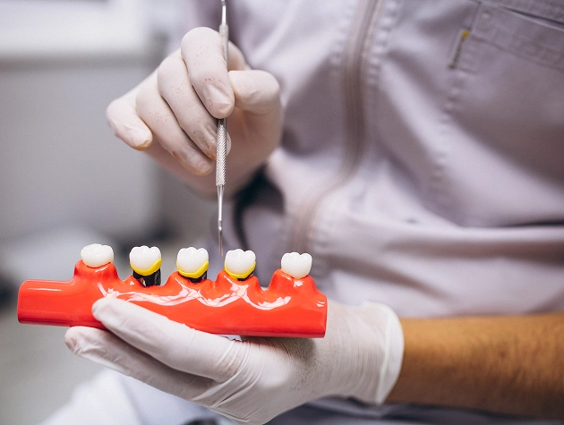 What Are Dental Implants?