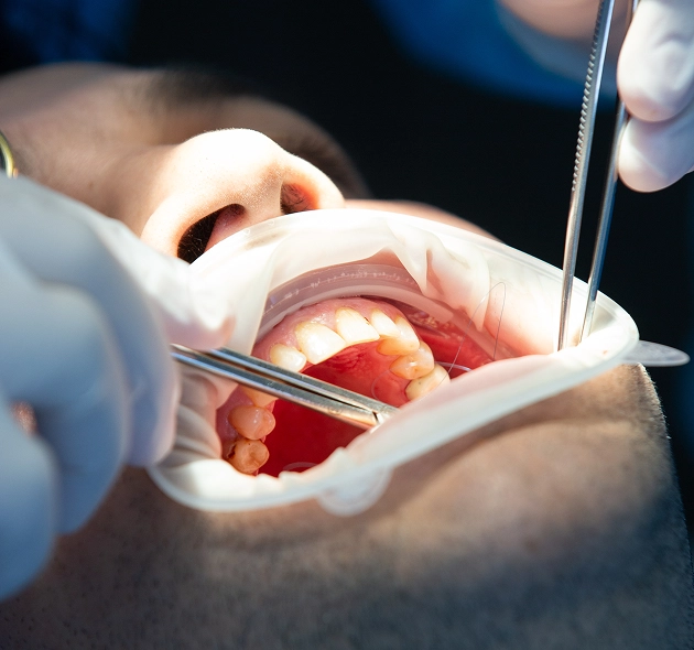 What Is a Root Canal?